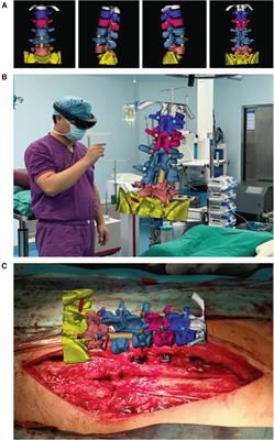 The application of extended reality technology-assisted intraoperative navigation in orthopedic surgery